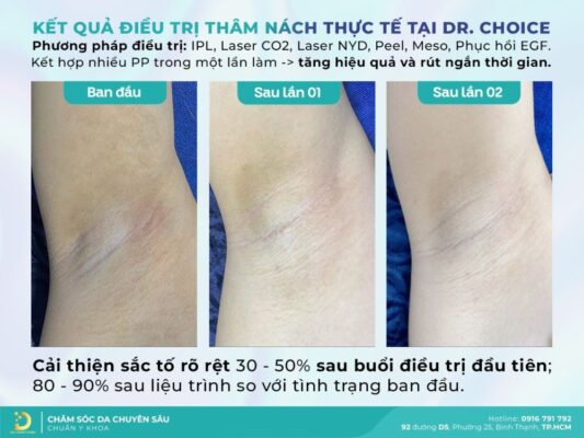 Có nên trị thâm nách/bẹn tại Dr. Choice Clinic HCM? 10