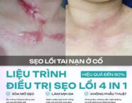 Trải nghiệm điều trị sẹo lồi tại Dr. Choice Clinic: Review chân thực! 2