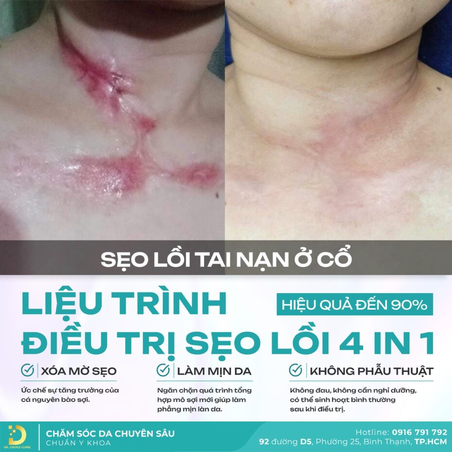 Trải nghiệm điều trị sẹo lồi tại Dr. Choice Clinic: Review chân thực! 3