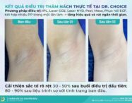 Có nên trị thâm nách/bẹn tại Dr. Choice Clinic HCM? 4